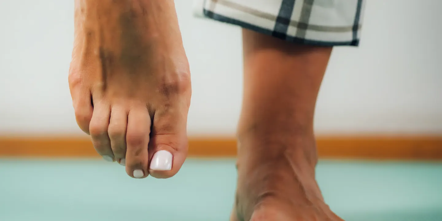 Close-up of bare feet with the base of the big toe in view, the joint affected by hallux rigidus