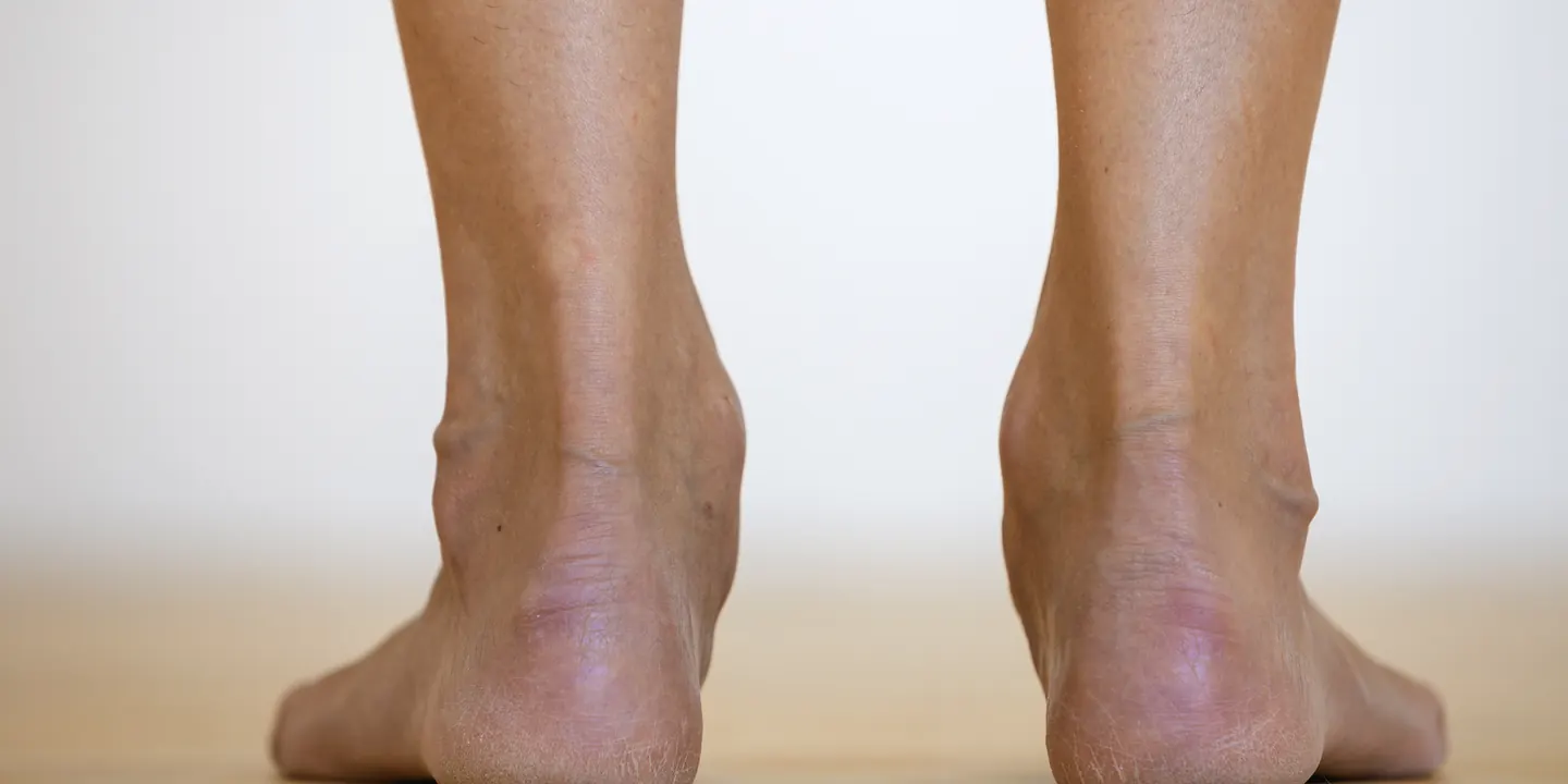 Rear view of two bare feet standing, showing the heel position of a collapsing arch